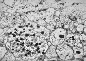 M, 3y. | suprarenal neuroblastoma M, 3y. | suprarenal neuroblastoma